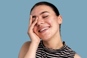 Gaes !!! Jangan Bingung Ada Bekas Jerawat, Hilangkan Dengan Cara Alami Ini