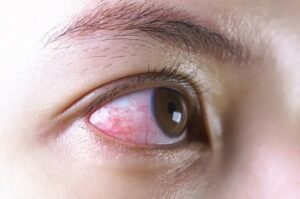 Gaes !!! Sayangi Kesehatan Mata Dari Kelelahan Bekerja