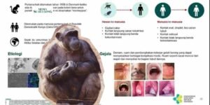 Gaes !!! MPOX :  Pria Penyuka Sesama Jenis Paling Rentan