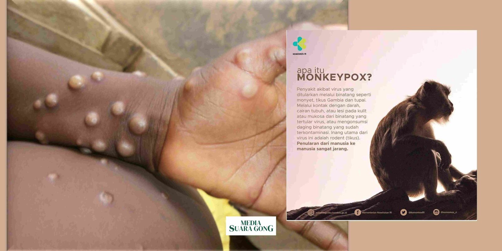 Kenali Gejala Cacar Monyet atau Monkeypox (MPOX)/