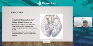 Gaes !!! Ambliopia: Mata Malas yang Perlu Ditangani Sejak Dini