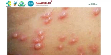 Kasus Cacar air, penyakit yang disebabkan oleh virus Varicella, kini mulai menyebar di kalangan anak-anak dan dewasa di beberapa daerah di Indonesia