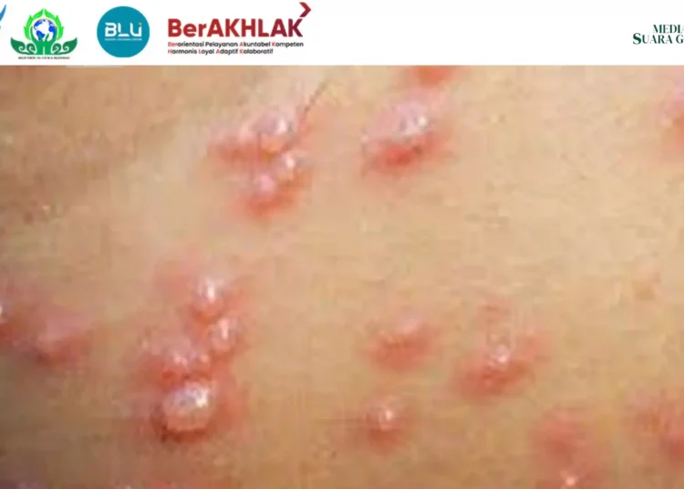 Kasus Cacar air, penyakit yang disebabkan oleh virus Varicella, kini mulai menyebar di kalangan anak-anak dan dewasa di beberapa daerah di Indonesia