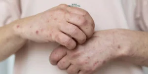 Gaes !!! Infeksi Campak Dunia Naik 10 Juta Kasus, WHO Ungkap Penyebabnya
