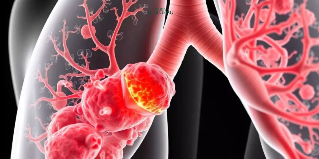Selain Merokok, Ini Penyebab Kanker Paru-Paru