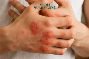 Cara Mengatasi Eksim di Jari karena Alergi