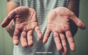 gambar telapak tangan yang terkena penyakit campak 2025