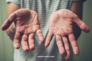 Campak Ditahun 2025 Kok Bisa Kasusnya Meledak Lagi Segede Ini?